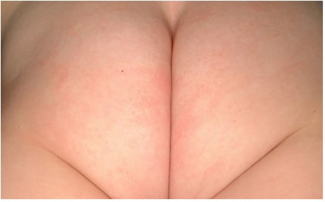 Imagen de dermatitis del pañal leve con pápulas