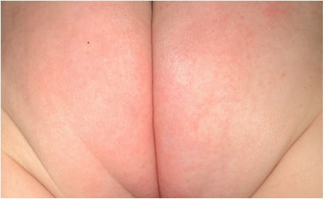 Imagen de dermatitis del pañal leve a moderada